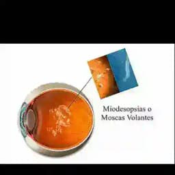 miodesopsias - moscas volantes Profile