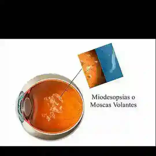 miodesopsias - moscas volantes Profile